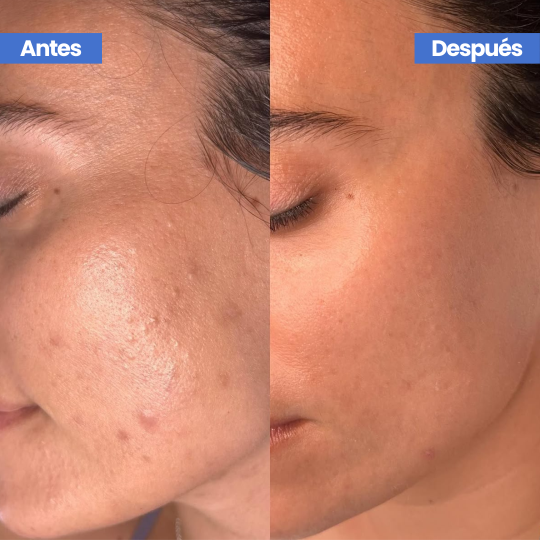 Natria® Loción Secante de Granos 24H